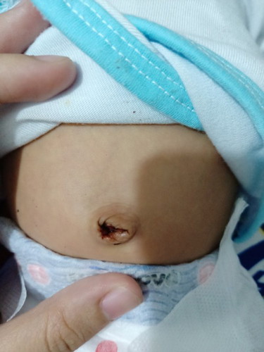 Pusod nagdurugo