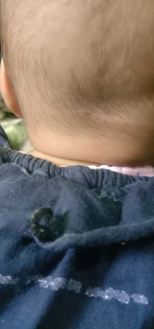 Kulit kepala bayi kering