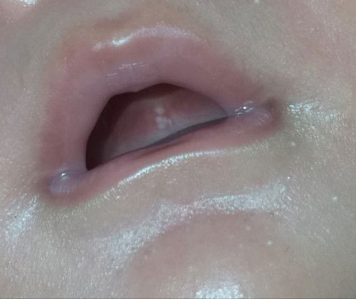 น้องมีเม็ดสีขาวในปาก