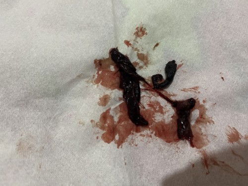 lagi usia 11w6d kok keluar gumpalan gini apa keguguran ya bund?