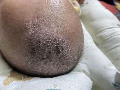 Cara menghilangkan kerak pada kulit kepala bayi