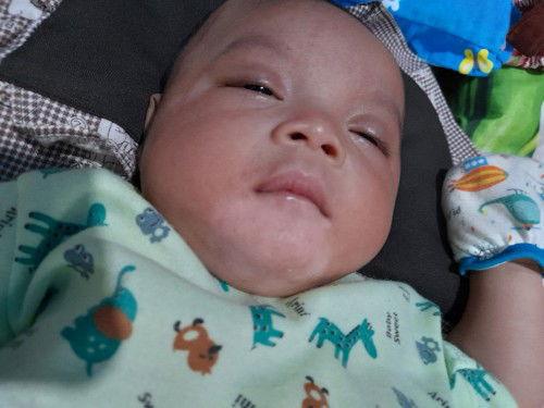Bercak putih pada wajah bayi