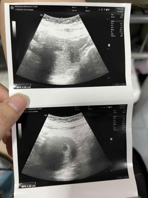 ท้องลมใช่ไหมค่ะ