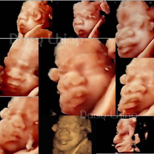 31 W + 2 D Ultrasound 4D 👶🏻