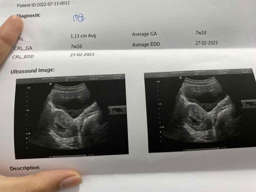 ท้อง7วีคปวดท้องเหมือนปวดอึแล้วมีเลือดออกหาหมอคนแรกอันตร้าซาวบอกเจอตัวเด็กแต่ไม่ได้ยินเสียงหัวใจอีกวันไปหาหมอคนที่2ซาวผ่าน