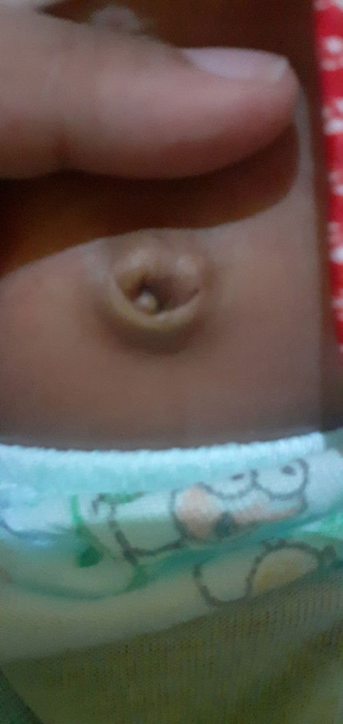 Pusar bayiku masih seperti ini bun padahal usia nya sudah 26 hari