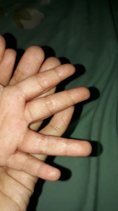 Bruntusan ditangan bayi 1 tahun