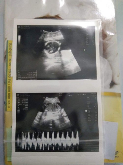 คุณลุงหมอบอกว่า ผู้หญิง100%ค่ะ