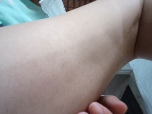 Các mom cho e hỏi,e sinh xong đã chân bị như thế này,có m nào bị k như e k,dùng gì để hết ạ