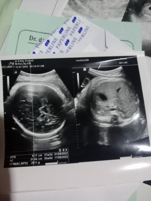 Hasil USG 36-37 week