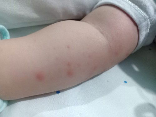 Rashes or Prickly heat?