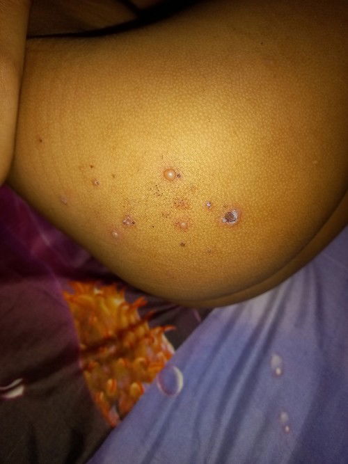 Bintik² isi cairan dan nanah