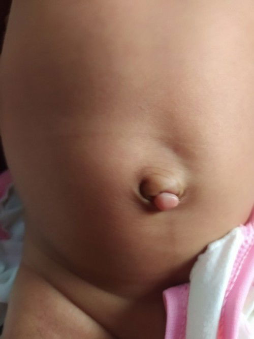 Tali pusar tumbuh daging