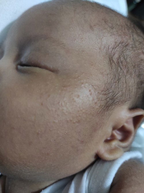 Baby acne po ba ito?