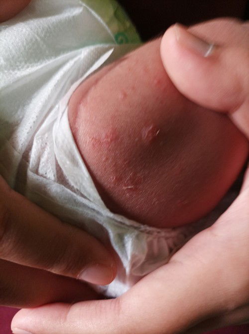 Bayi saya umur 24 hari bun, di paha sama tangannya ada bintik² seperti itu ya, kira² itu bahaya g ya