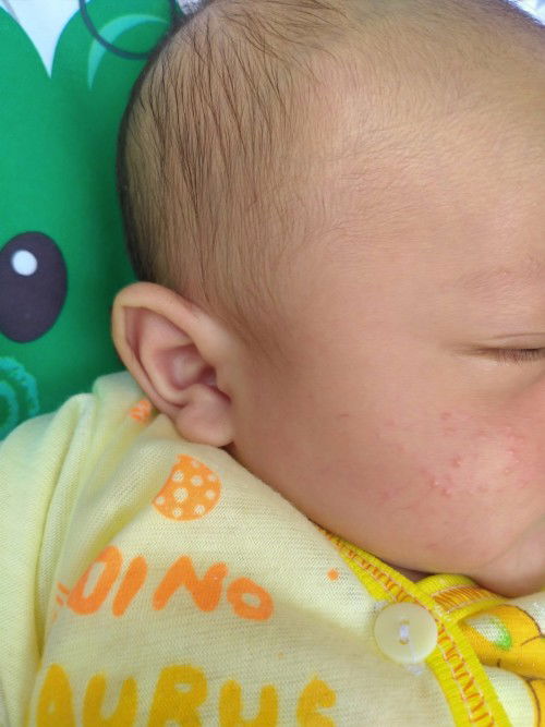 Bruntusan di pipi baby