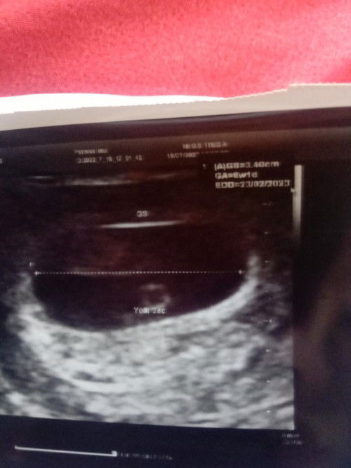 Hamil 8 week hanya terlihat yolk sac saja
