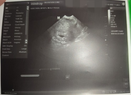 LMP: 7weeks & 6days
Ultrasound Age: 5weeks & 1day