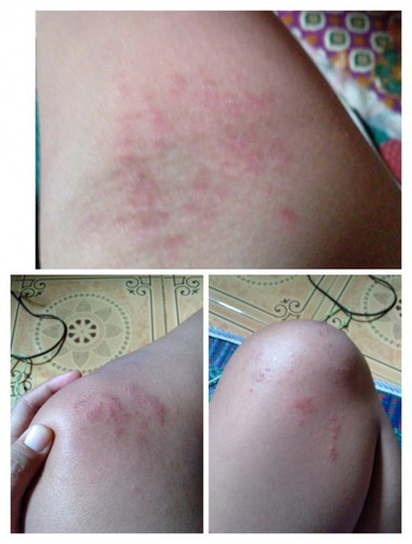 Gatal² , pada tangan