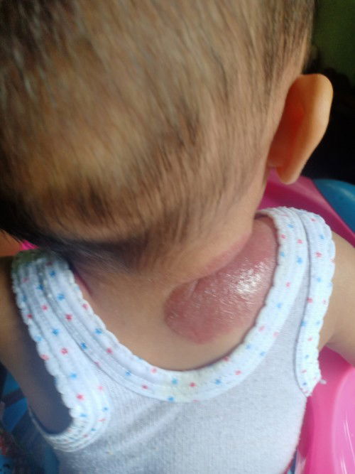 Ruam merah pada kulit. Tolong berbagi info obat nya