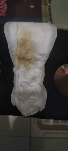Yeast infection discharge?