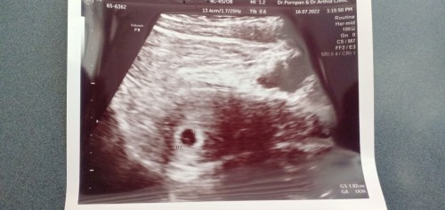 ท้อง6วีคถุง1.02เซนเล็กไหมคะ หมอบอกเจอถุงแต่ยังไม่เจอตัวค่ะ เรามีปวดฟหน่วงท้องเลยไปซาวด์ดู