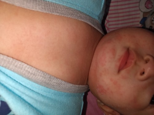 Halo semua nak tanya and suggest macam mana nak baik kan kulit bayi?