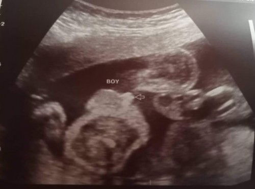 Baby boy ❤️ Low Lying