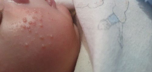 Jerawat bayi