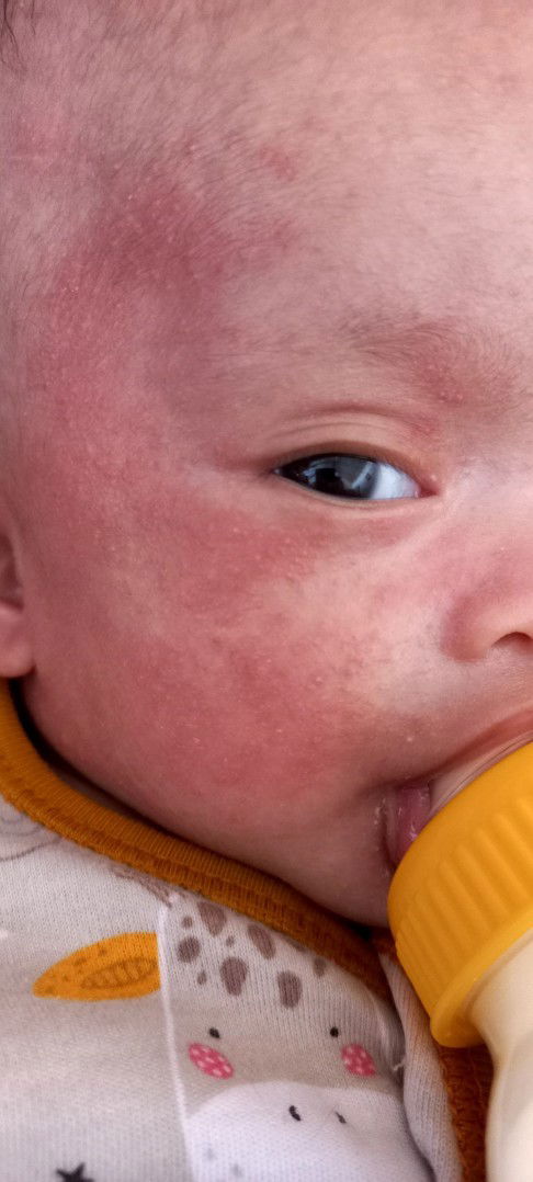 Muka anak bruntusan nya parah