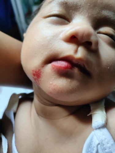 Strawberry birth mark