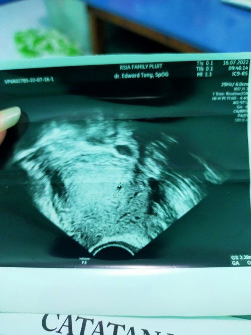 Mom mau tnya kenapa ya usia kandungan dari perhitungan hpht sm pas d usg beda? Itu wajarkah? Thanks