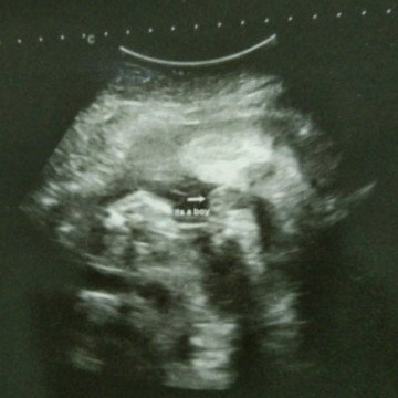 Gender baby