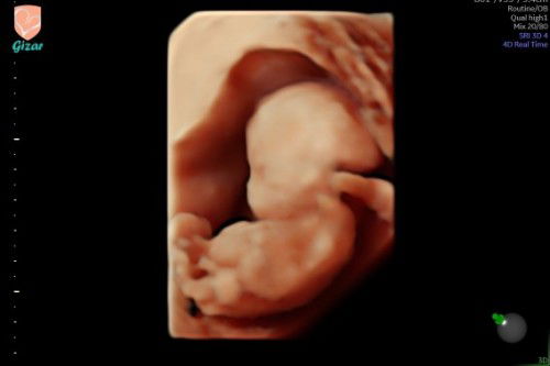 Mau tanya mam , wajar tidak hasil usg 17 week seperti ini krna aku liat org sudak keliatan bentuk
