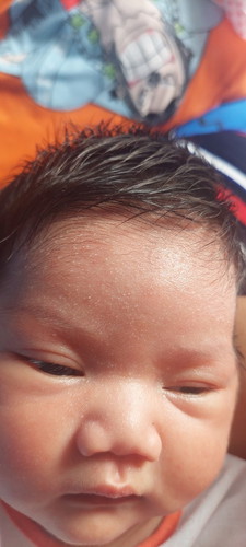 ผื่นขึ้นที่หน้าผากลูก