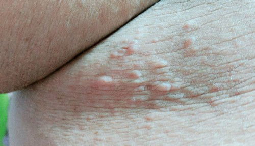 แม่ๆคนไหนกำลังท้องและมี ตุ่มผื่นขึ้นแบบนี้บ้างคะบริเวณจักแร้กับพุง