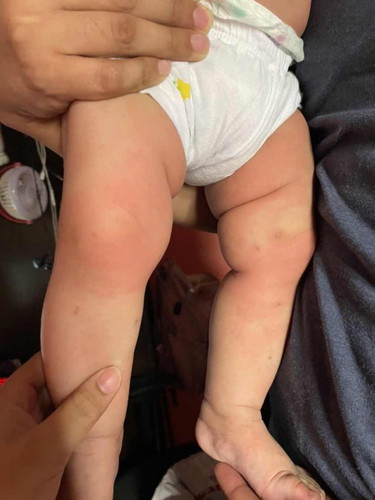 Skin Rashes? May naka experience na po ba ng ganitong rashes ni baby?