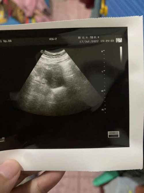 Pengalaman adanya bercak hamil muda