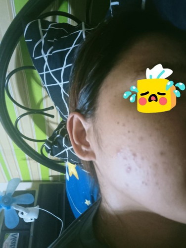 Pimples nakakahiya