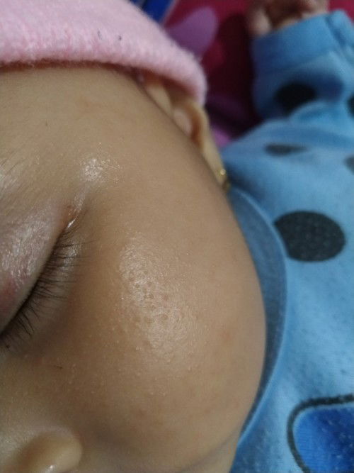 krim yg cocok untuk wajah baby 5bulan yg beruntusan dan kering???