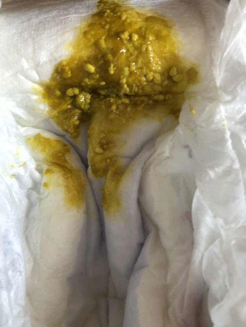 baby kerap membuang dan najis ada biji putih