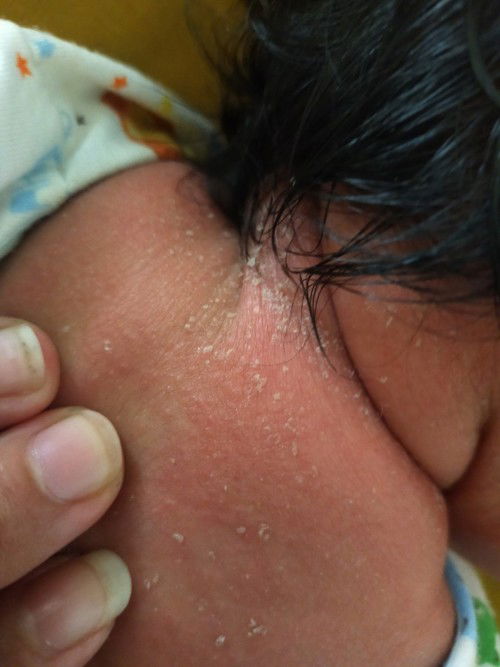 ผิวลอกหลังเป็นผื่น