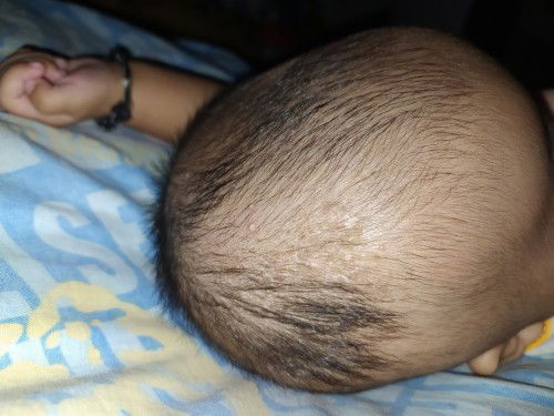 Kepala anak saya kayak ada keraknya