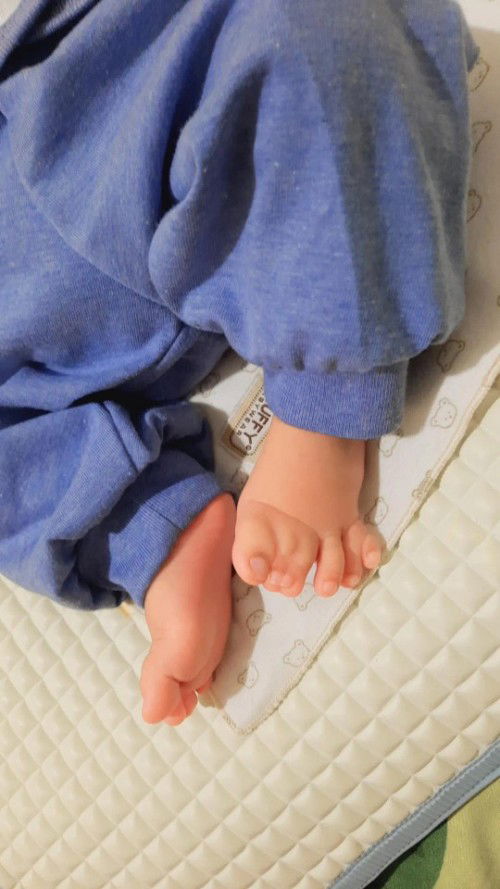 Jari kaki bayi dempet, kaoan waktu yg tepat untuk oprasi?