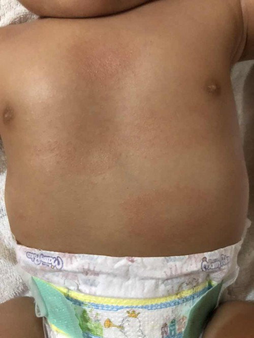 Bintik2 pada dada dan perut bayi 4 bulan