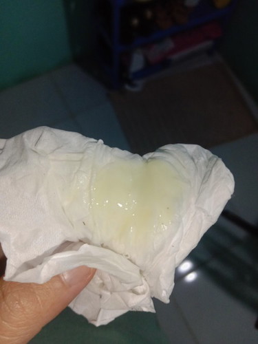 Keputihan kaya gini normal gk yah bun , aku keputihan kaya gini pas masuk 5-6 bulan dan sampai skrng