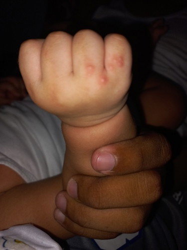 Ano po kaya itong butlig sa kamay ni anak, 4months na po sya.
Salamat po sa sasagot.