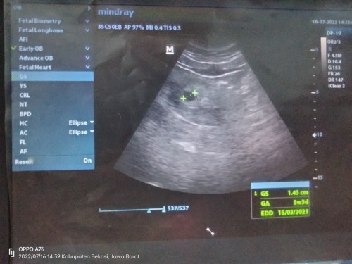 Bun. Saya mau tanya kmren saya USG dan kehamilan saya baru 5 minggu baru haml ank prtma emg gtuyabu