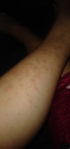Ilang weeks po ba bago matanggal to 32weeks napo ko ngayon lang nagsilabasan sobrang kati po:((