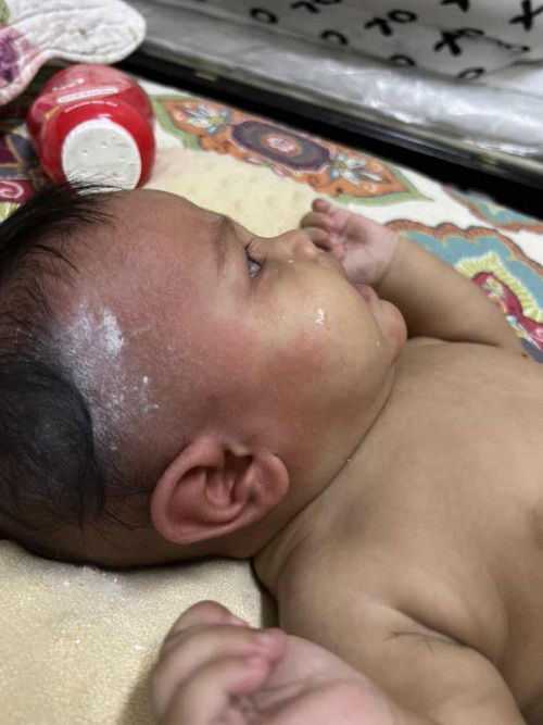 Allergy Alergik Alahan. Baby 4 bulan. Any experinece mum please help. Baby full bf.